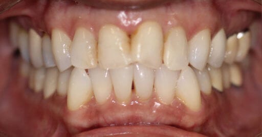 before periodontist