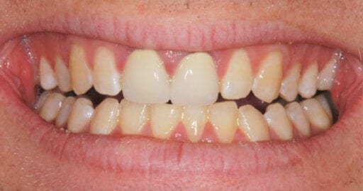 before dental braces