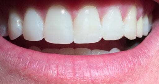 after chipped teeth repair