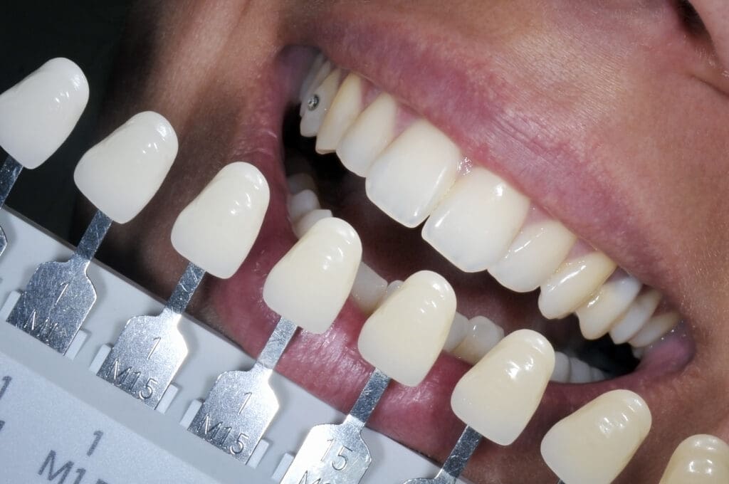 teeth whitening in emerald isle nc