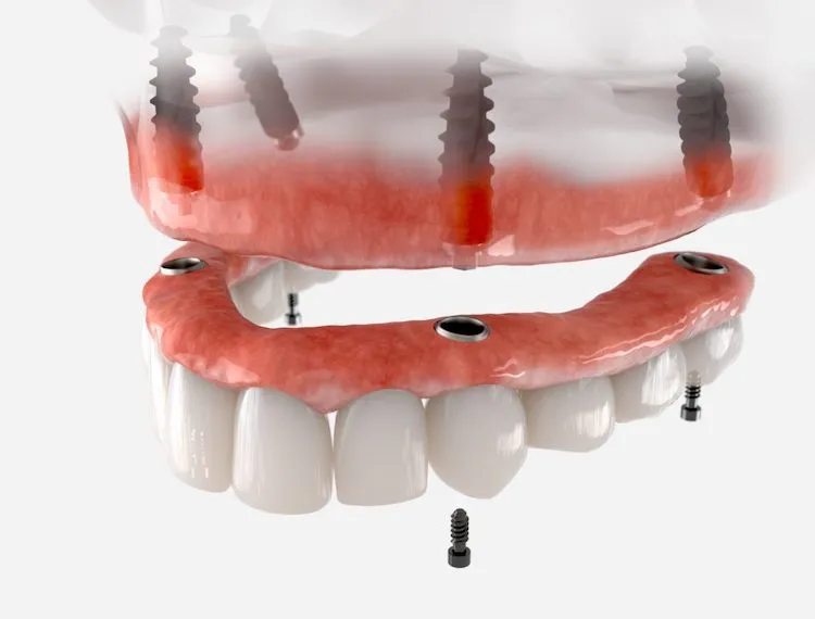 Dental Implants vs. Dentures Emerald Isle NC