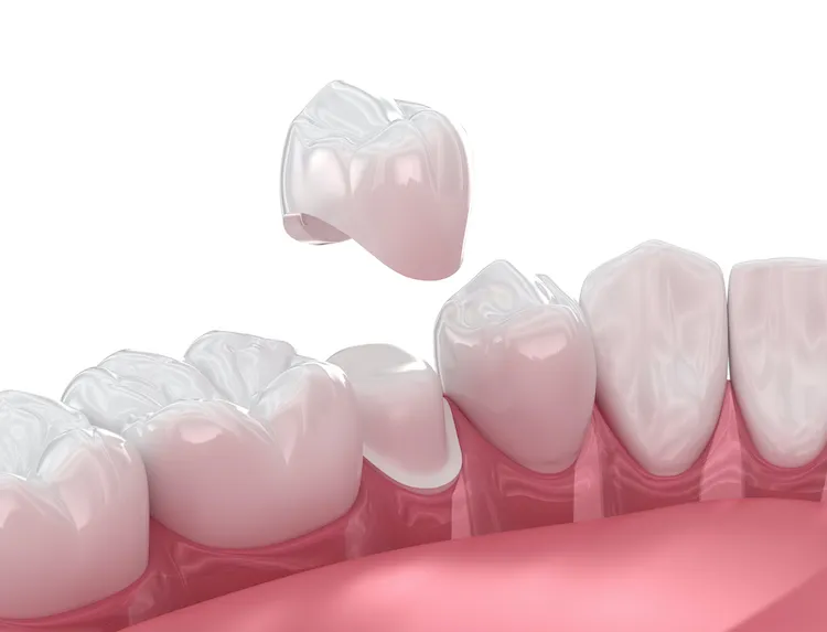 Same-Day Crowns: How CEREC Technology Helps in Emerald Isle, NC